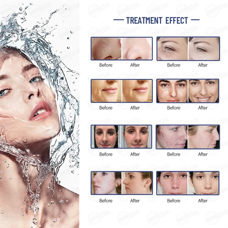 The Basic And Classic Beauty Machine For H2O2 Skin Care best